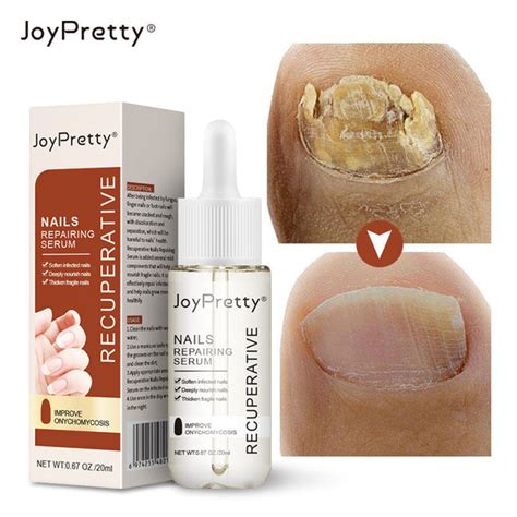 joy pretty nails repairing serum|Athletes Foot Toenail Fungus Serum .